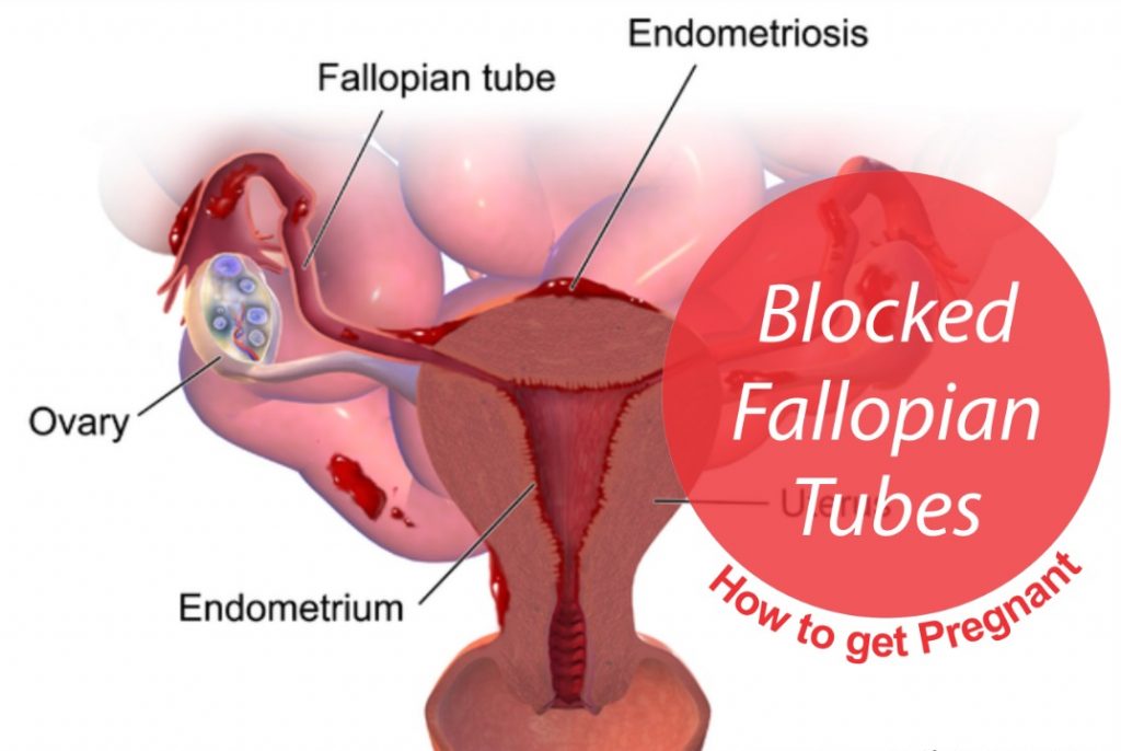 7-steps-to-get-pregnant-with-blocked-fallopian-tubes-antvt