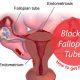 7 steps to get pregnant with blocked fallopian tubes