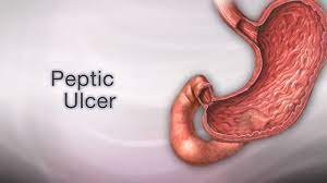 8 Foods to Avoid When You Have a Peptic Ulcer