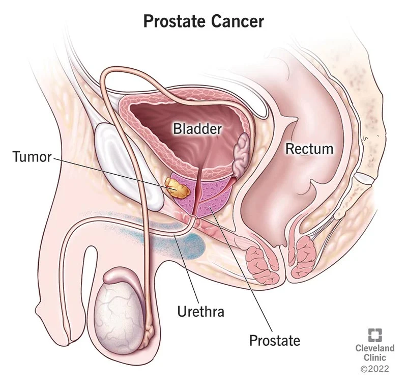 Understanding Prostate Cancer: A Detailed Guide on Symptoms, Treatment, and Prevention Strategies