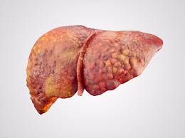 Understanding Liver Disease: What You Need to Know