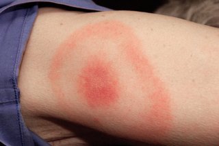 Unraveling the Mysteries of Lyme Disease: An In-depth Analysis of its Causes, Symptoms, and Treatment Protocols